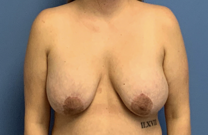 Breast-Revision-with-Lift--amp--Augmentation | Before Breast Revision